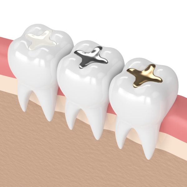 3d,Render,Of,Teeth,With,Gold,,Amalgam,And,Composite,Inlay