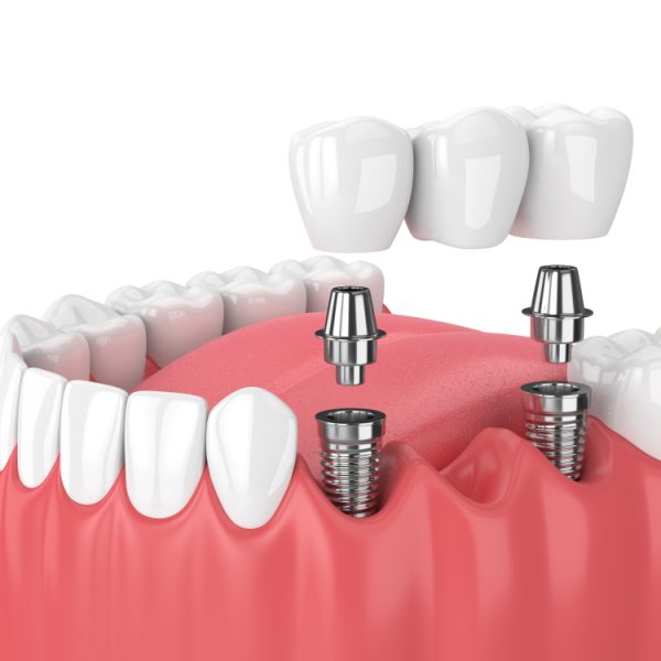 3d,Render,Of,Jaw,And,Implants,With,Dental,Bridge,Over